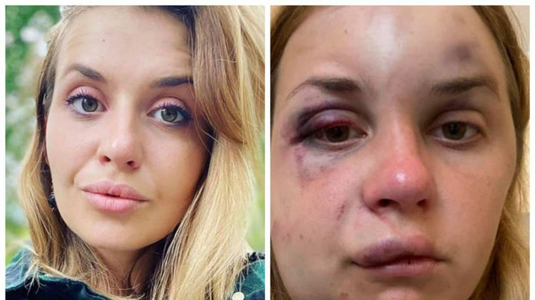 В результате нападения у девушки была сломана челюсть. Фото: Facebook