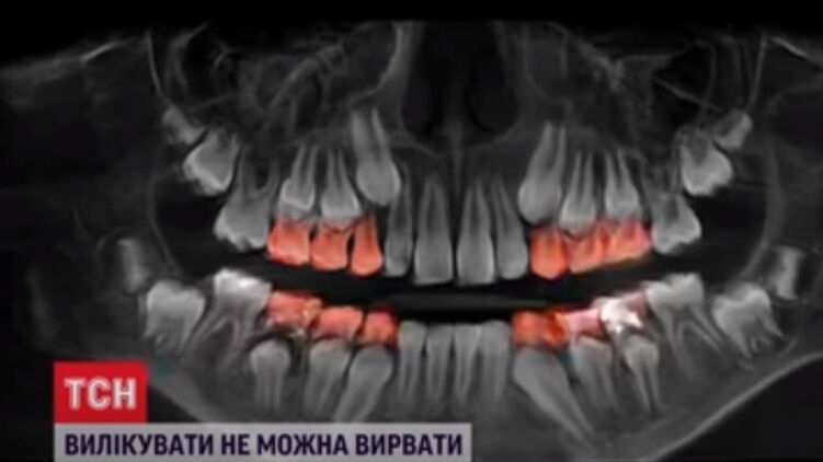 Удаление 12 молочных зубов поставило под угрозу прорезывание постоянных. Скриншот с видео